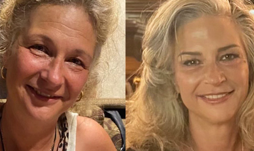 non surgical facelift thread lift before after result